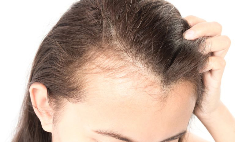 Nhận diện và cải thiện tình trạng tóc rụng